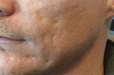 Cystic Acne Scars