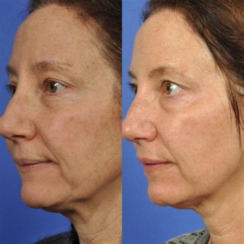 Microneedling Before and After Wrinkles - See the Difference!