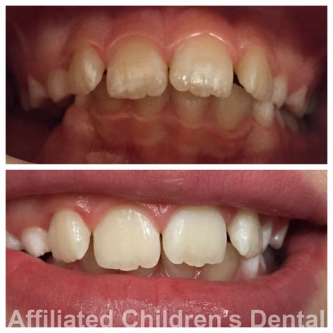 white marks teeth children