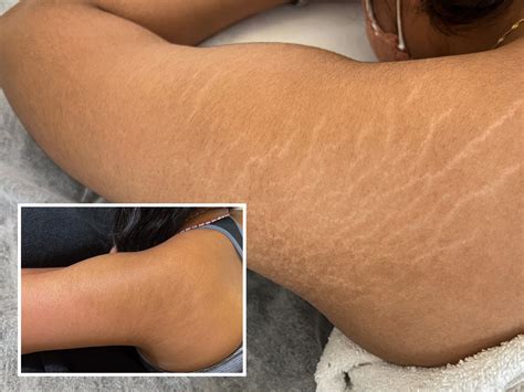 Permanent Stretch Mark Removal Inkless Stretch Mark Removal: A
