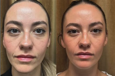 Sculptra: The Injectable That Grows with You – What to Expect Long-Term - House of Aesthetix