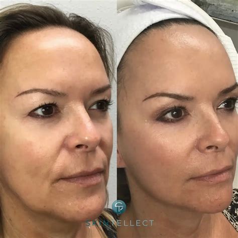 Fotona 4D Laser Facelift In Tampa | Non-Surgical Skin Tightening & Lifting
