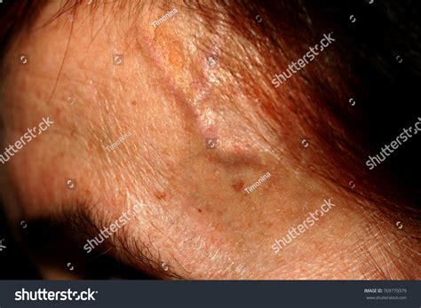 Inflated Veins On Temple Swollen Arteries Foto Stok 769779379 ...