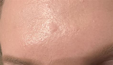 What is going on with these flat raised bumps on my forehead?? : r/30PlusSkinCare