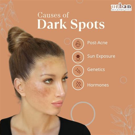 Dark Spot Treatment - Urban Skin and Hair Clinic