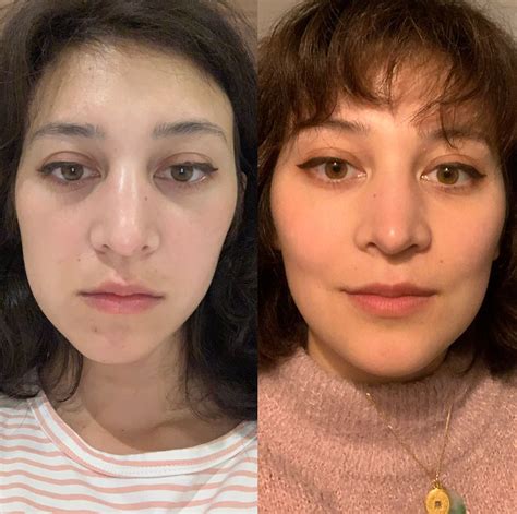 Real Patient Review: Korean Double Jaw + V-line Surgery Results (Before & After)