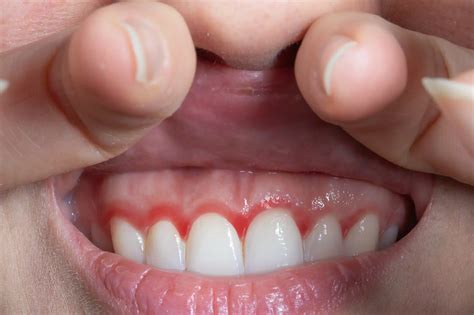 Are My Gums Receding? | Dr Helen