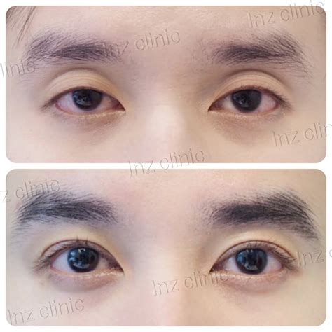 How to get double eyelids permanently without surgery online