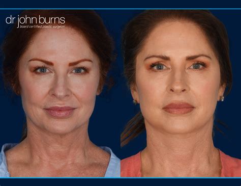 Facial Fat Grafting with Micro and Nano Fat- Dr. John Burns – Dr John Burns