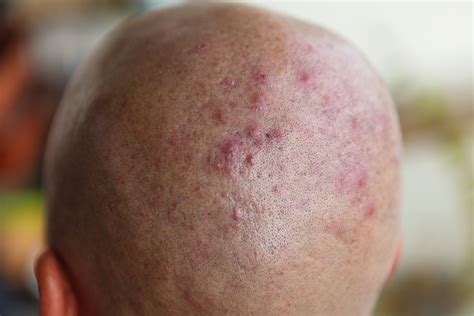 Types Of Folliculitis On Face