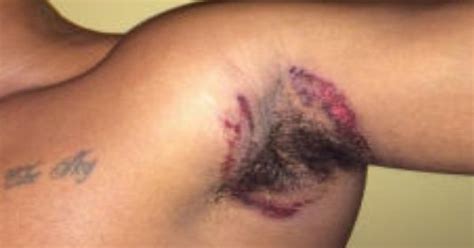 Lawsuit blames Old Spice deodorant for severe armpit rashes