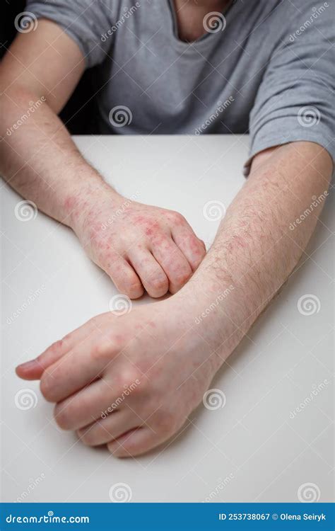 Itchy Rash On Hands While Pregnant at Ronald Kinney blog