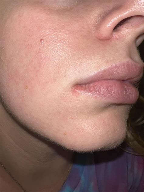 Cold Sore Or Pimple