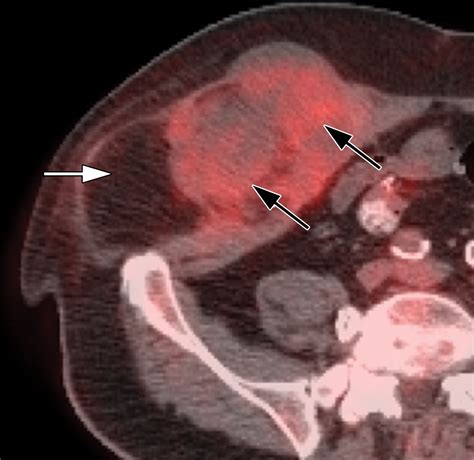 Imaging of Abdominal Wall Masses, Masslike Lesions, and Diffuse ProcessesRadioGraphics
