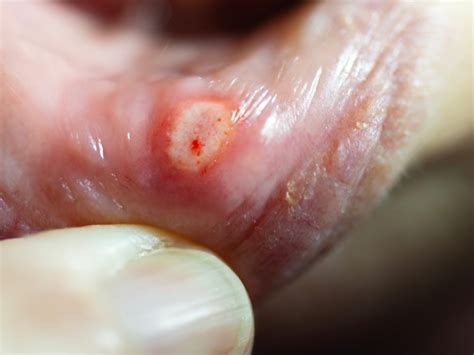 Canker Sore Stages Stages Of Cold Sores & How To Treat Fever Blisters
