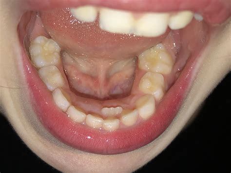 My five year old daughter has an adult tooth growing in behind her baby teeth. She hasn’t lost ...