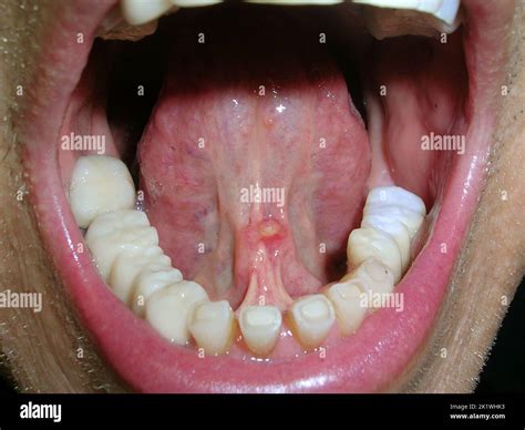 Mucocele under tongue Stock Photo - Alamy