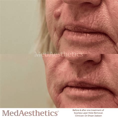 Laser Wart Removal Perth | MedAesthetics