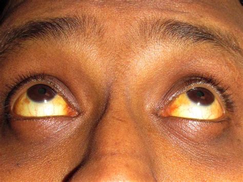 Jaundice: Causes, Symptoms, and Treatment Options