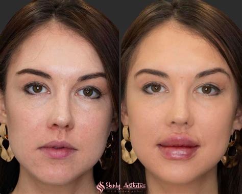 Russian Lip Filler Before & After Results - Skinly Aesthetics