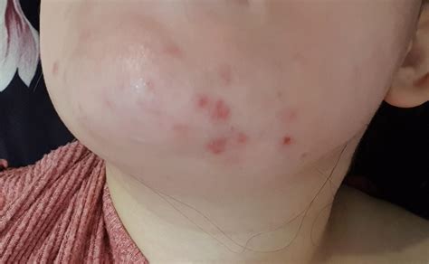 2 Week - Hormonal Cystic Acne Treatment Update : r/acne
