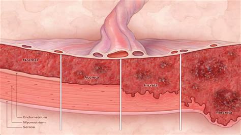 PLACENTA ACCRETA SPECTRUM DISORDERS.pptx