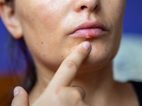 Herpes labial: qué es, síntomas, causas y remedios caseros para ...