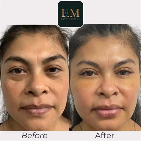Under Eye Fat Transfer for a Youthful Appearance