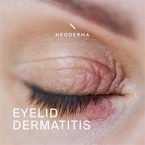 Eyelid Dermatitis - NEODERMA