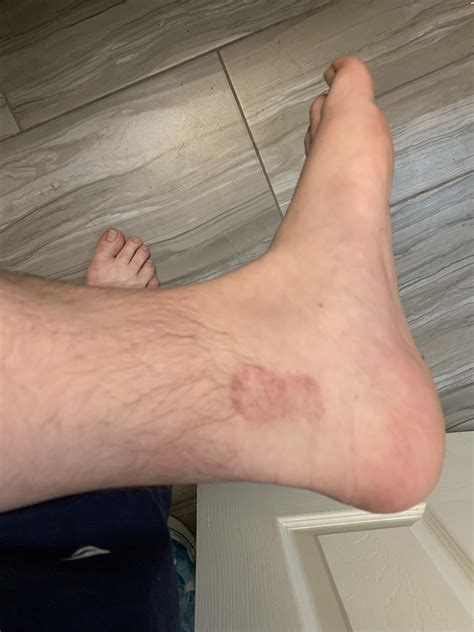 Any idea what this could be? Ankle starting itching a bit at work and ...