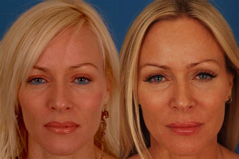 What Is A Botox Eye Lift at Lucile Hart blog