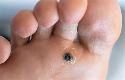 Effective Plantar Wart Removal at The Foot Practice