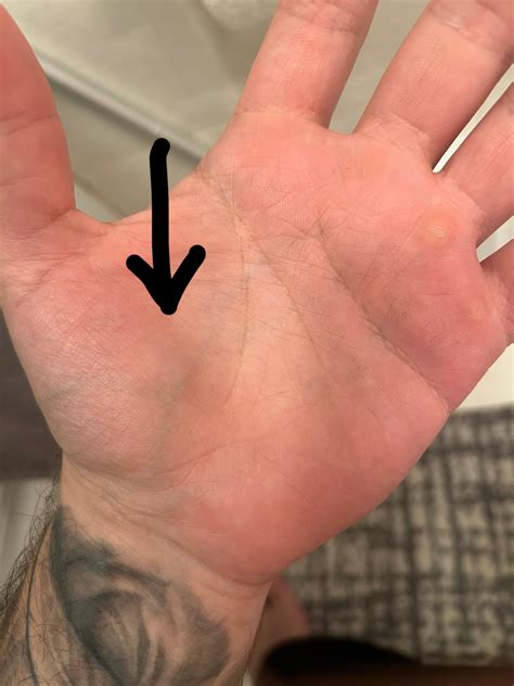 Vein in my palm feels swollen and is discolored, anyone know what this could be? (I work with my ...