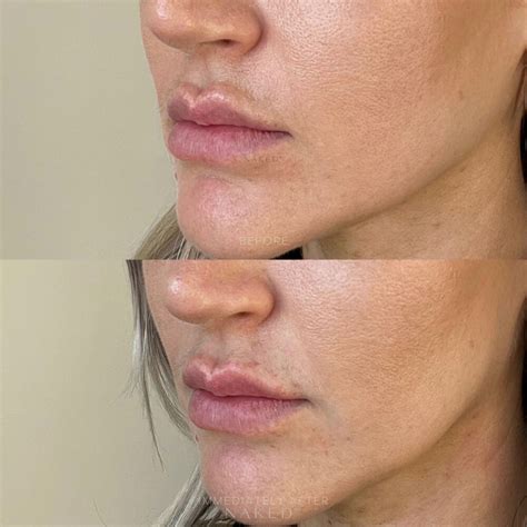 Hylenex | Hyaluronidase Injection for Safe Filler Dissolving – NAKEDMD Medspa