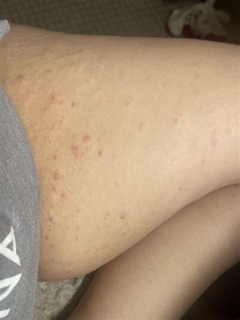 Any idea what kind of rash this is? Inner thigh and where my arm folds ...