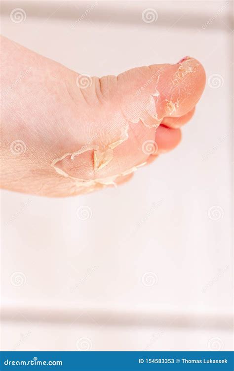 After the Red Rash and the Strawberry Tongue Caused by Scarlet Fever the Affected Skin Often ...