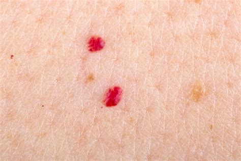 Cherry Angioma: Symptoms, Causes, Diagnosis, Treatment