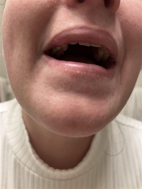 How to get rid of white bumps around lower lip? : r/Skincare_Addiction