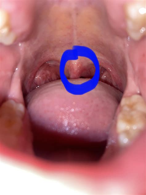 Uvula Anormal