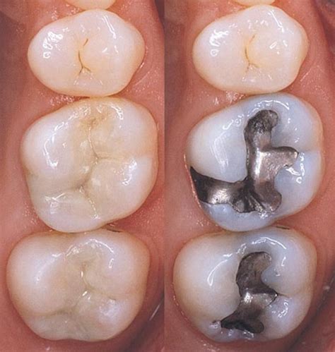 Tooth Cavity Filling