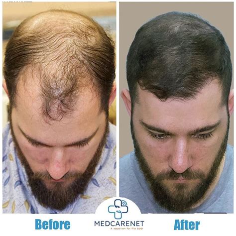 Hair Transplant Services in Turkey | MedCareNet