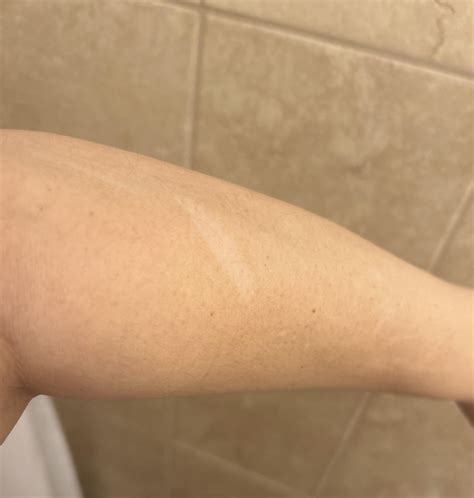 Does anyone know what these white patches are on my arm and how to get rid of them ? : r ...