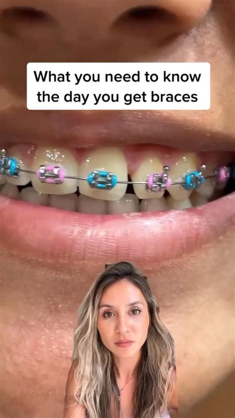 Cute braces colors – Artofit
