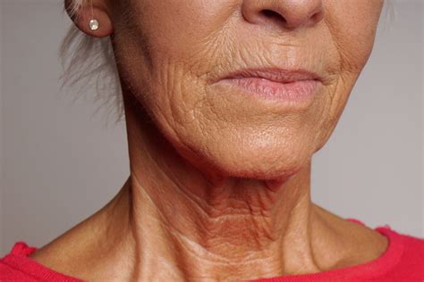 Wrinkled Neck - The McLoughlin Face Clinic