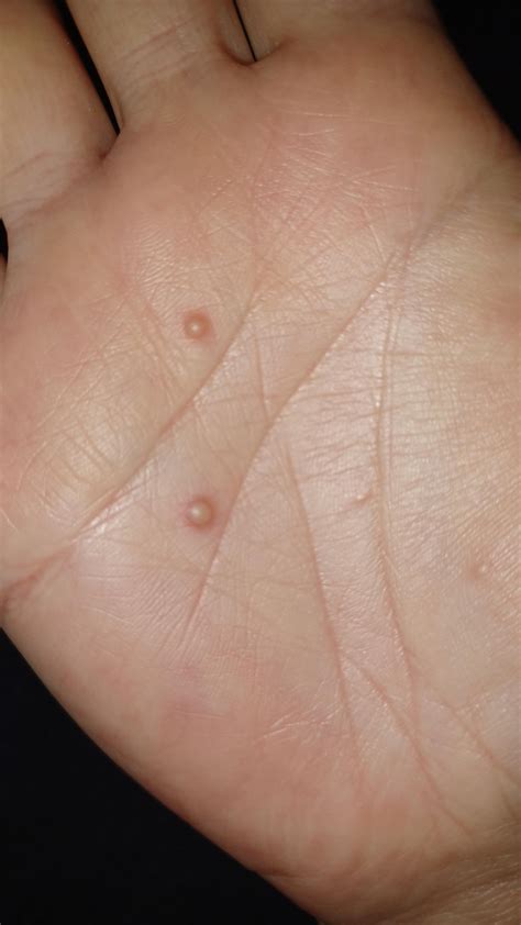 Bumps not itchy on palm of hand : r/DermatologyQuestions