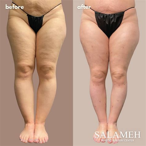 Lipedema vs. Cellulite: Understanding the Differences & Treatment Options