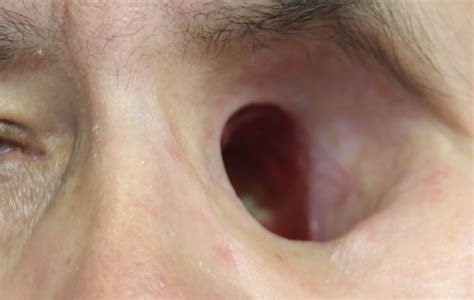 Eye Out Of Socket Drawing - Drawing Tips Guide