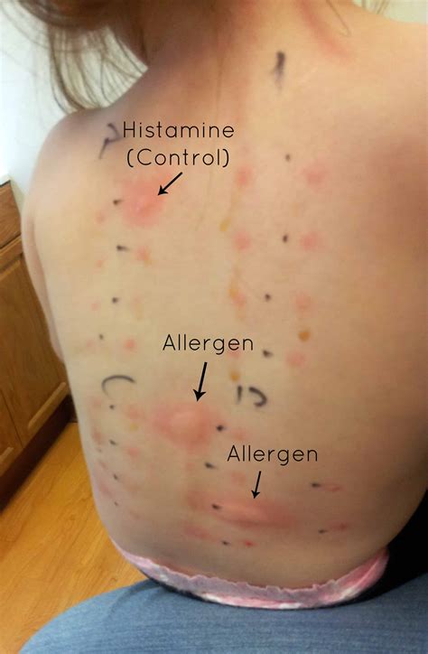 Understanding Allergy Test Results