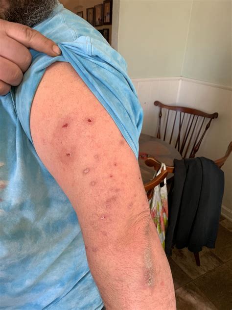 Spider Bites In My Bed