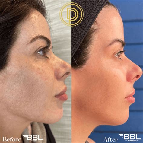 Bbl Light Treatment Before And After Shelly Lighting - vrogue.co